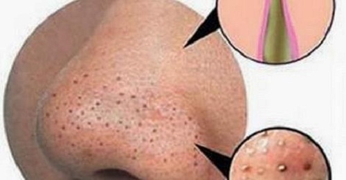 Comment éliminer les points noirs naturellement ? Comment éliminer les points noirs naturellement ?