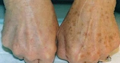 Taches sur les mains : comment les atténuer ?