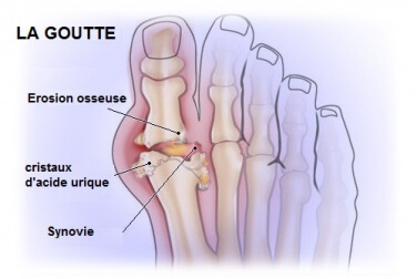 Maladie de la goutte
