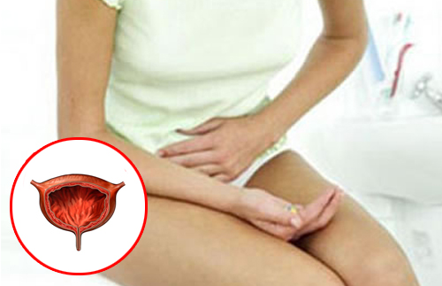 Les causes des brûlures urinaires chez la femme