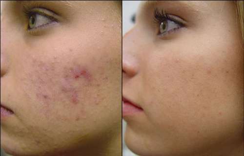 4 masques maison anti-acné