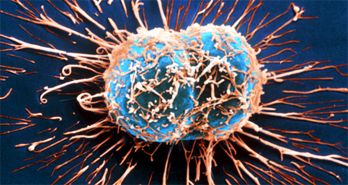 11 symptômes du cancer que la plupart des gens ignorent 11 symptômes du cancer que la plupart des gens ignorent