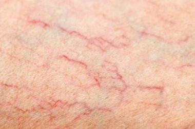 Que faire si vous avez des varices ?