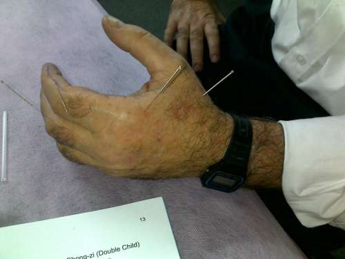 Traitement avec acupunture de la main