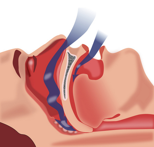 Traitement naturel pour combattre l’apnée du sommeil Traitement naturel pour combattre l’apnée du sommeil