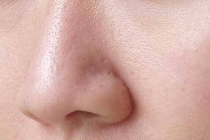 pores dilatés du nez