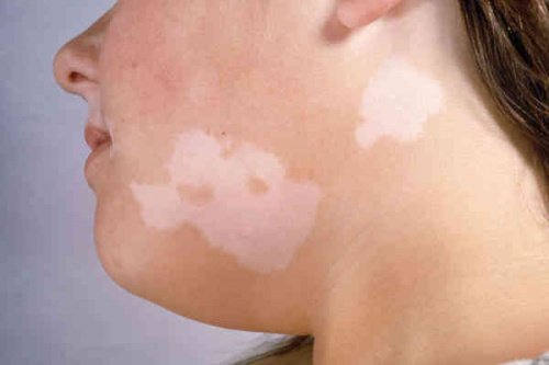 Des taches blanches sur la peau peuvent indiquer un vitiligo