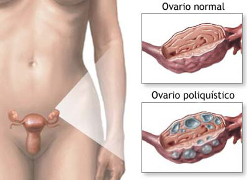 Traiter naturellement le syndrome des ovaires polykystiques
