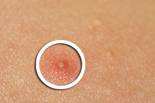 Bouton d'acné
