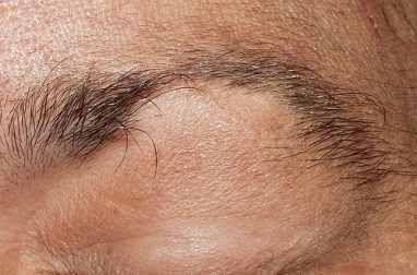 Traitement contre l'alopécie des sourcils et des cils