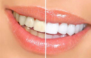8 aliments qui provoquent un jaunissement des dents