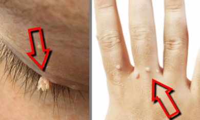 Remèdes maison efficaces pour éliminer les verrues