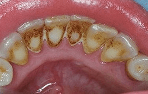 Comment éliminer la plaque dentaire et améliorer la santé orale ?
