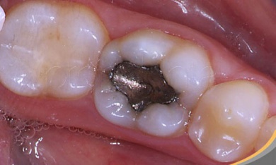 Les risques des plombages dentaires pour la santé