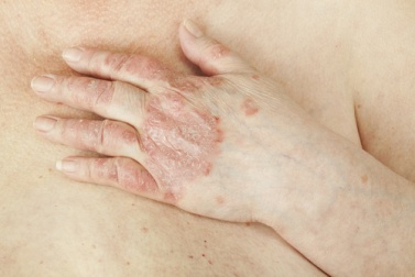 Le psoriasis peut-il se soigner ?