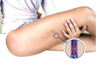 Symptômes de la thrombose veineuse.