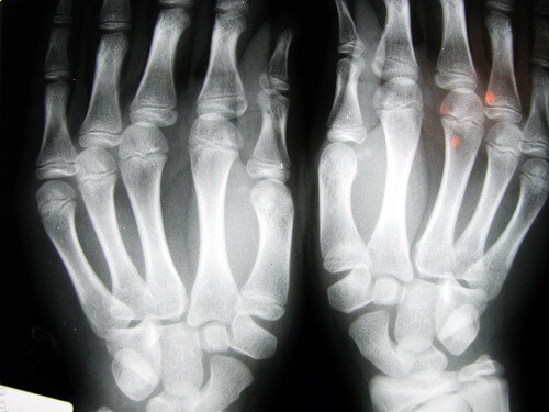 Ostéoarthrite liée aux doigts.