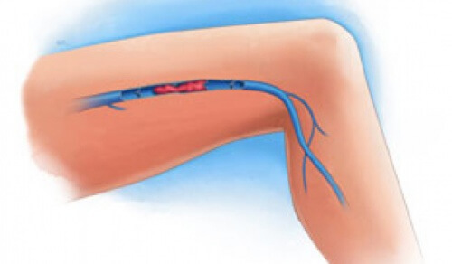 Symptômes d'une thrombose veineuse dans les jambes