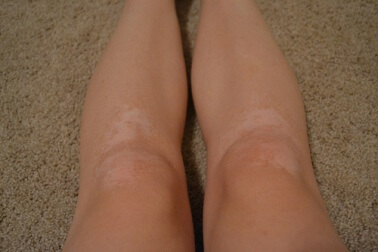 Le vitiligo est difficile à soigner.