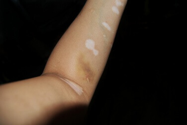 Le vitiligo est une maladie qui touche plusieurs zones du corps.