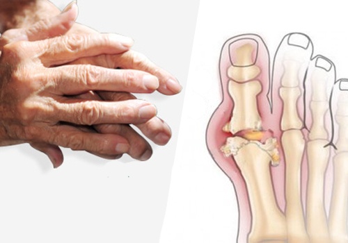 arthrite des mains et pieds 