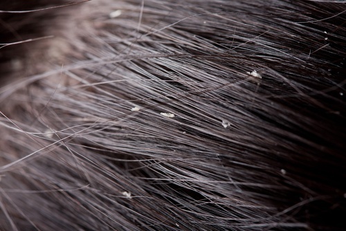 Pellicules-500x334