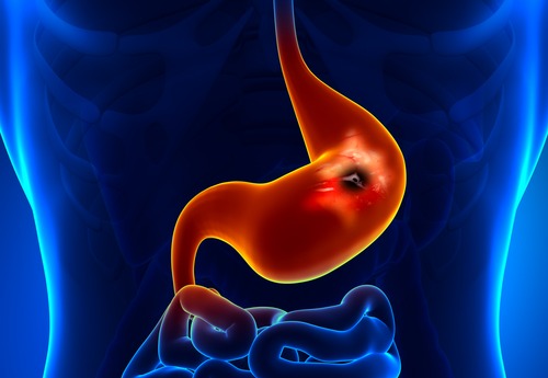 Le tabac peut être une des causes de l'ulcère gastro-duodénal.