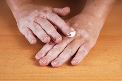 Le vitiligo : pourquoi il apparaît et comment l'éliminer ?