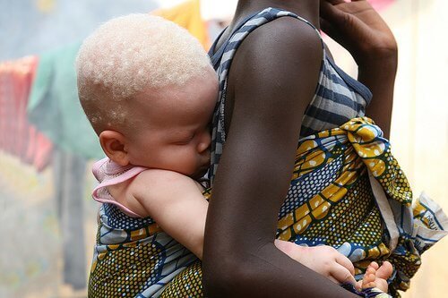 Albinisme en Afrique