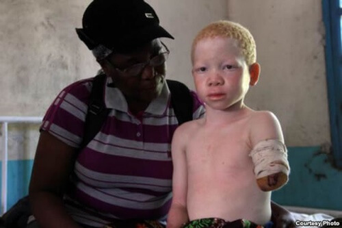 Image result for nigerian albinism