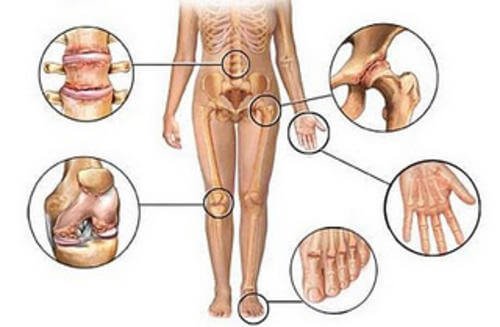 Causes de la douleur aiguë aux bras et aux jambes