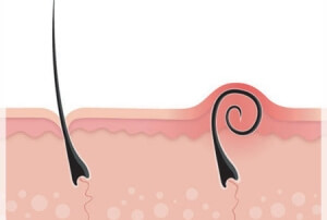 comment éliminer le duvet excessif