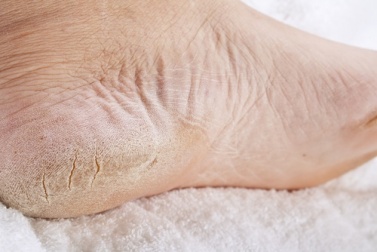 8 remèdes maison définitifs pour les talons crevassés