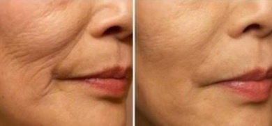 Comment éviter les rides autour de la bouche ?