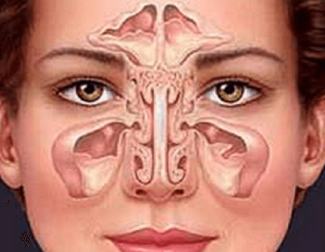 Comment soigner naturellement la sinusite ?