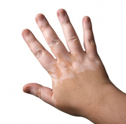 Les remèdes pour soigner le vitiligo sont très coûteux.