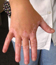Le vitiligo est un problème dégénératif de la peau.