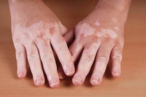 5 remèdes maison pour atténuer le vitiligo