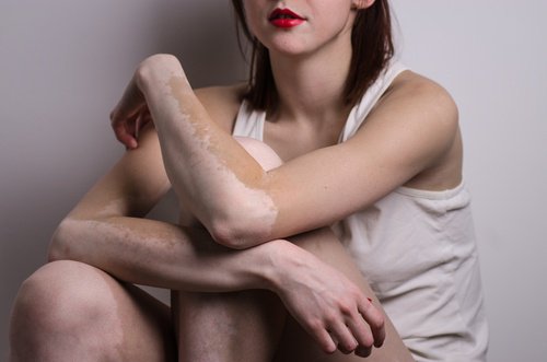 Quelles-sont-les-causes-du-vitiligo-?