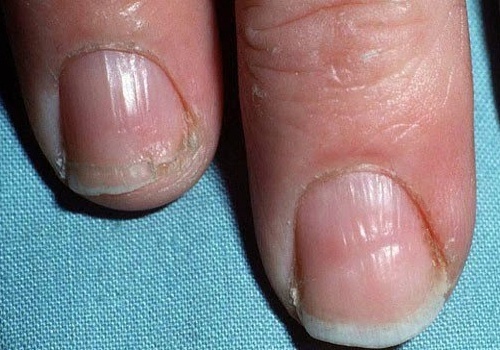 Signal-ongles-500x350