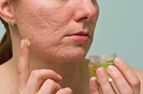 6 remèdes maison pour éliminer l'acné et les points noirs