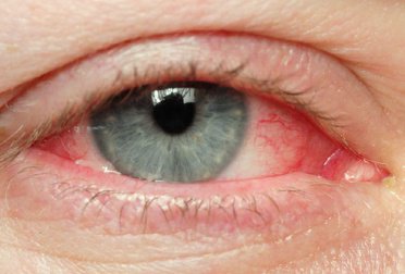 Yeux-irrites-372x252