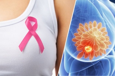 10 signes qui peuvent révéler un cancer du sein