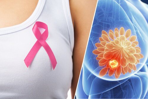 10 signes qui peuvent révéler un cancer du sein