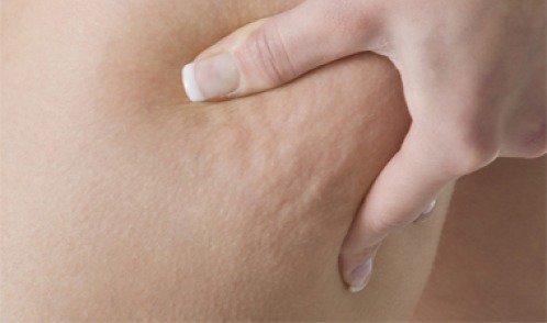 Comment traiter la cellulite.