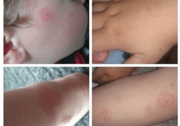 Découvrez les causes et symptômes de la maladie de Lyme