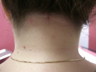 Des remèdes naturels pour le traitement et la prévention de la dermite