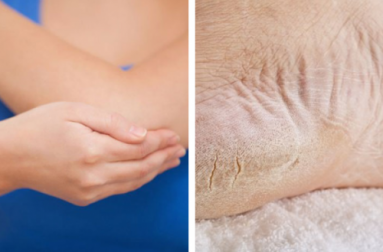 Atténuez la sécheresse des pieds et des coudes en une semaine
