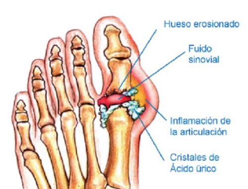Dites adieu à la goutte avec ce puissant traitement naturel