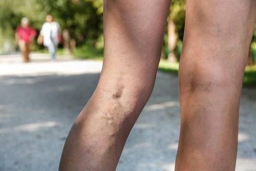 Les veines varices dans les jambes.